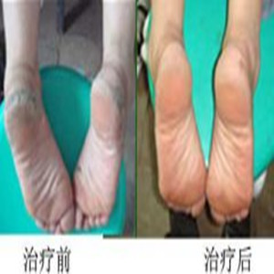 手足癣治疗